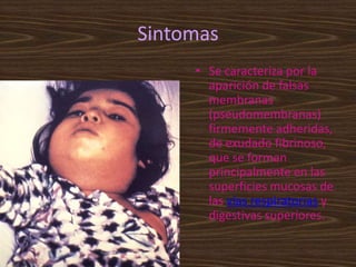 Sintomas
     • Se caracteriza por la
       aparición de falsas
       membranas
       (pseudomembranas)
       firmemente adheridas,
       de exudado fibrinoso,
       que se forman
       principalmente en las
       superficies mucosas de
       las vías respiratorias y
       digestivas superiores.
 