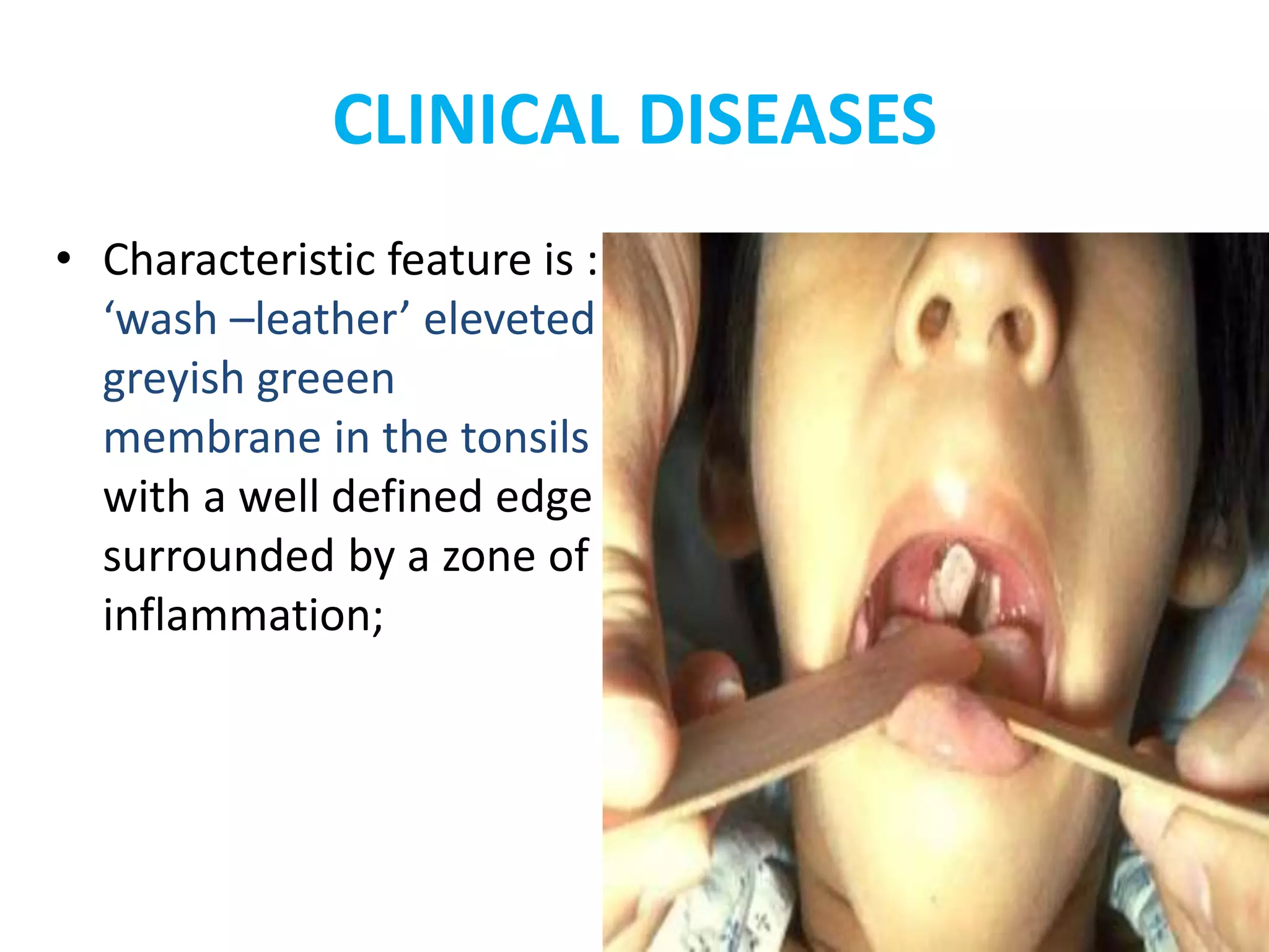 CLINICAL DISEASES
• Characteristic feature is :
‘wash –leather’ eleveted
greyish greeen
membrane in the tonsils
with a well defined edge
surrounded by a zone of
inflammation;
 
