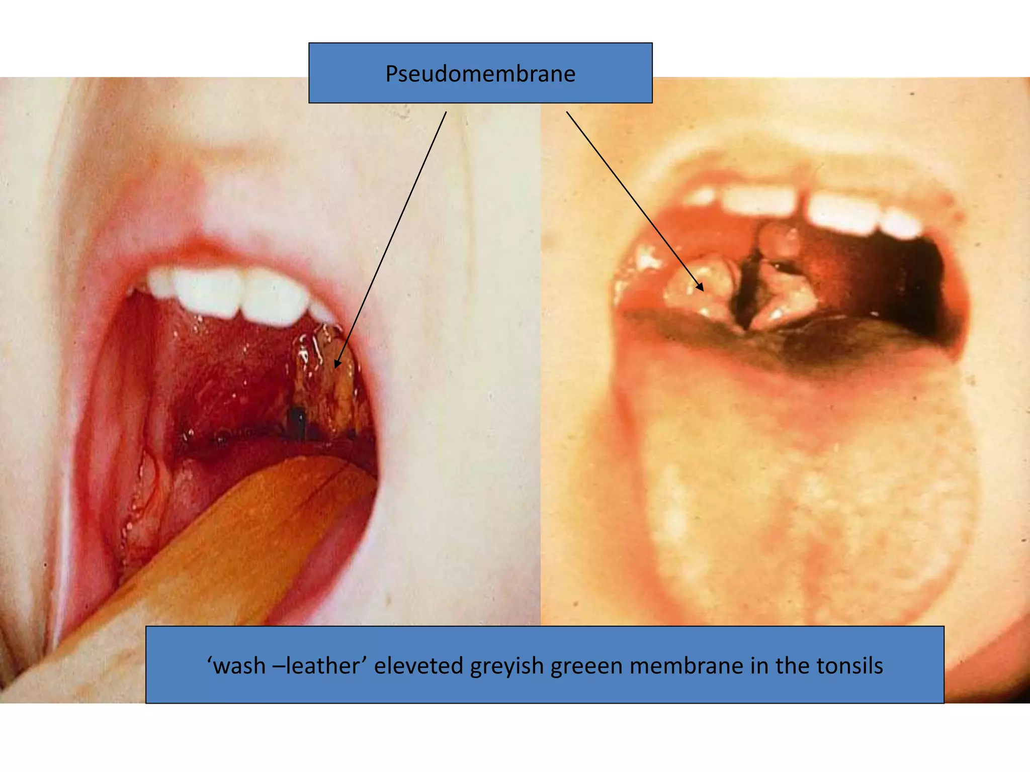 ‘wash –leather’ eleveted greyish greeen membrane in the tonsils
Pseudomembrane
 