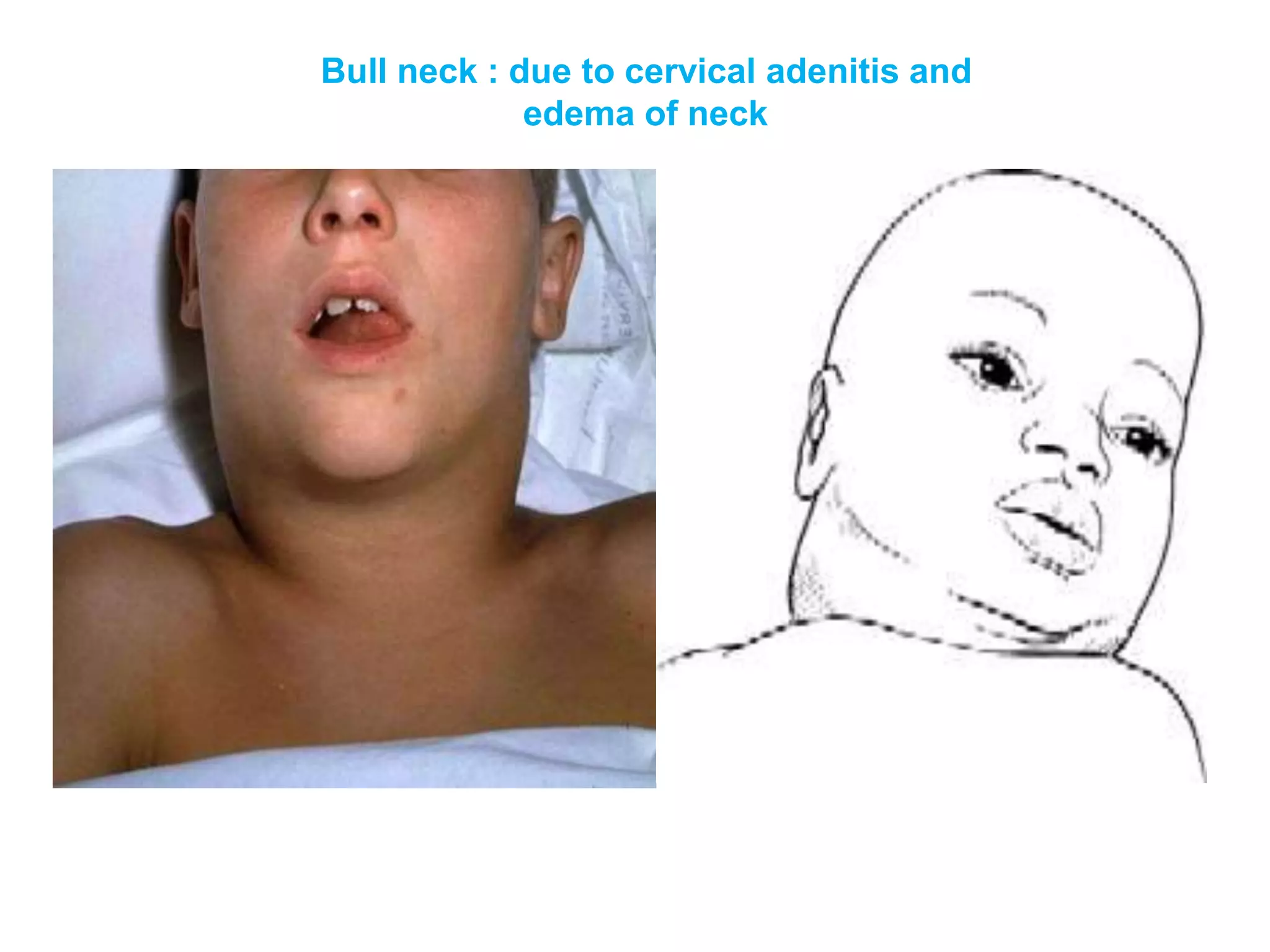 Bull neck : due to cervical adenitis and
edema of neck
 