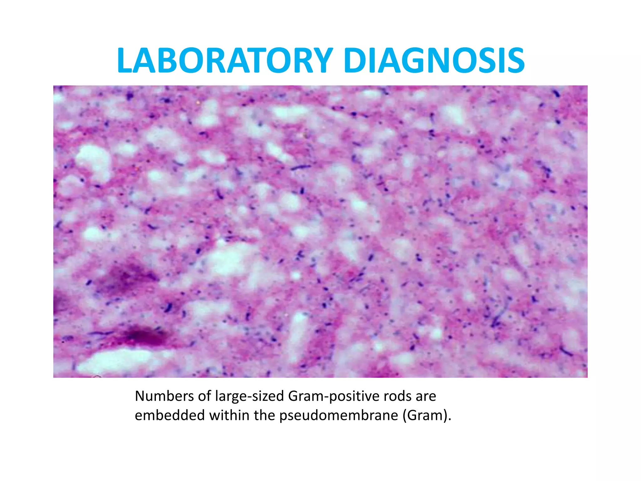 Numbers of large-sized Gram-positive rods are
embedded within the pseudomembrane (Gram).
LABORATORY DIAGNOSIS
 