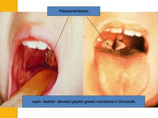 ‘wash –leather’ eleveted greyish greeen membrane in the tonsils
Pseudomembrane
 