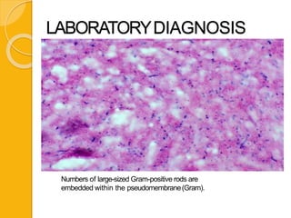 Numbers of large-sized Gram-positive rods are
embedded within the pseudomembrane(Gram).
LABORATORYDIAGNOSIS
 