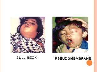 BULL NECK PSEUDOMEMBRANE
 
