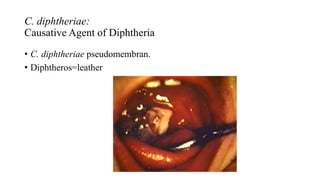 C. diphtheriae:
Causative Agent of Diphtheria
• C. diphtheriae pseudomembran.
• Diphtheros=leather
 