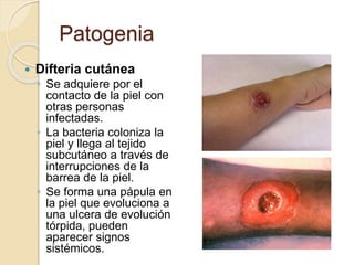 Patogenia
 Difteria cutánea
◦ Se adquiere por el
contacto de la piel con
otras personas
infectadas.
◦ La bacteria coloniza la
piel y llega al tejido
subcutáneo a través de
interrupciones de la
barrea de la piel.
◦ Se forma una pápula en
la piel que evoluciona a
una ulcera de evolución
tórpida, pueden
aparecer signos
sistémicos.
 
