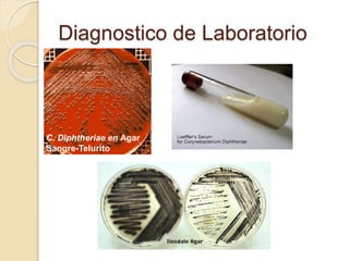 Diagnostico de Laboratorio
C. Diphtheriae en Agar
Sangre-Telurito
 