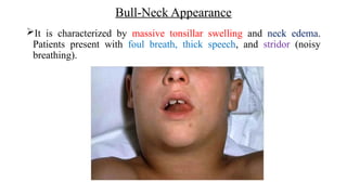 Bull-Neck Appearance
It is characterized by massive tonsillar swelling and neck edema.
Patients present with foul breath, thick speech, and stridor (noisy
breathing).
 