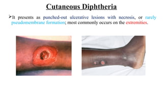 Cutaneous Diphtheria
It presents as punched-out ulcerative lesions with necrosis, or rarely
pseudomembrane formation; most commonly occurs on the extremities.
 