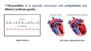 ARRHYTHMIAS DILATED CARDIOMYOPATHY
Myocarditis: It is typically associated with arrhythmias and
dilated cardiomyopathy.
 