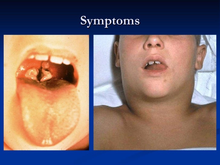 Corynebacterium diphtheriae b.carl