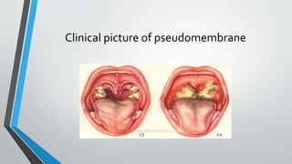 Clinical picture of pseudomembrane
 