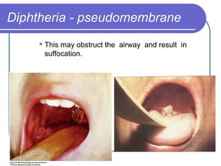 Diphtheria Pseudomembrane