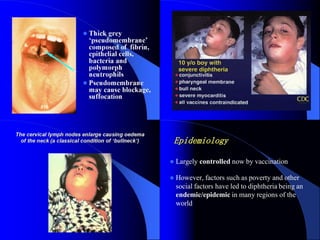  Largely controlled now by vaccination
 However, factors such as poverty and other
social factors have led to diphtheria being an
endemic/epidemic in many regions of the
world
Epidemiology
 