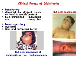 Clinical Forms of Diphtheria
 Respiratory
 Acquired by droplet spray
or hand to mouth contact
 Non-immunized individuals
are susceptible
 Non-respiratory
 Systemic
 Skin and cutaneous forms
Bull-neck appearance
Bull-neck appearance of
diphtheritic cervical lymphadenopathy
 