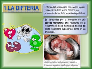 Enfermedad ocasionada por efectos locales
y sistémicos de la toxina diftérica, un
potente inhibidor de la síntesis de proteínas.
Se caracteriza por la formación de una
pseudo-membrana gris resistente en el
recubrimiento de la membrana mucosa del
tracto respiratorio superior así como en las
amígdalas.
 