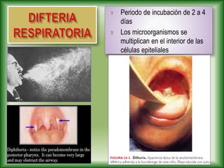 Periodo de incubación de 2 a 4
días
Los microorganismos se
multiplican en el interior de las
células epiteliales
 