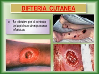 DIFTERIA CUTANEA
 Se adquiere por el contacto
de la piel con otras personas
infectadas
 
