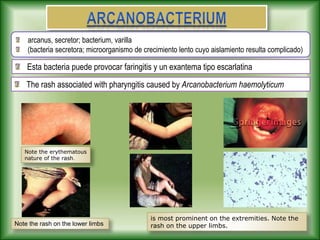 Esta bacteria puede provocar faringitis y un exantema tipo escarlatina
The rash associated with pharyngitis caused by Arcanobacterium haemolyticum
Note the erythematous
nature of the rash.
is most prominent on the extremities. Note the
rash on the upper limbs.
Note the rash on the lower limbs
arcanus, secretor; bacterium, varilla
(bacteria secretora; microorganismo de crecimiento lento cuyo aislamiento resulta complicado)
 
