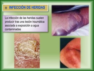 La infección de las heridas suelen
producir tras una lesión traumática
asociada a exposición a agua
contaminadas
 