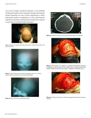 case of more complex craniofacial syndromes, in the possibility
of offering minimally invasive techniques through endoscopically
assisted osteotomies for some of these malformations it allows
reducing the number of complications, as well as shortening the
surgical time, blood loss and postoperative hospital stay compared
to conventional craniofacial surgery techniques.
Figure 1: Patient in an operative bed shows an inverted V-shaped abnormality in the
front of the skull.
Figure 2: Partial sinostosis that involves the sagittal suture in its anterior
portion and the coronal suture, with normal orbital ridges.
Figure 3: Bone structures in normal facial massif.
Figure 4: Deformity characterized by pointed frontal region was evidenced.
Figure 5: The surgery is to perform a complete frontoorbital osteotomy
in addition to the resection of the metopic suture, which includes both
orbital ceilings and the pterional region, a forehead remodeling occurs.
Figure 6: Soft flap towards the face, holes of parasagittal and paratemporal trepans
are made.
Volume 2 Issue 3-2019 Case Report
https://clinicsofsurgery.com/ 4
 