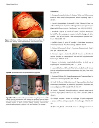 Figure 8: Performs synthesis of operative wound by planes.
References
1. Thompson D, Malcolm G, Jones B, Harkness W, Hayward R. Intracranial
ressure in single-suture craniosynostosis. Pediatr Neurosurg. 1995; 22:
235-240.
2. Panchal J, Amirsheibany H, Gurwitch R, Cook V, Francel P, Neas B, et
al. Neurodevelopment in children with single suture craniosynostosis and
plagiocephalyithout synostosis. Plast Reconstr Surg. 2001; 108: 1492-99.
3. Muenke M, Gripp K, Mc Donald-McGinn D, Gaudenz K, Whitaker L,
Bartlett SP, et al. A unique point mutation in the fibroblast growth factor
receptor 3 gene (FGFR3) defines a new craneosynostosis syndrome. Am J
Genet. 1997; 60: 555-564.
4. Havlik R, Azurin D, Barlett S, Whitaker L. Analysisand treatment of
severe trigonocephaly. Plast Reconstr Surg. 1999; 103: 381-90.
5. Collman H, Sorensen N, Krauf J. Consensus: Trigonocephaly. Child´s
Nerv Syst. 1996; 12: 664-668.
6. Hinojosa J, Esparza J, Muñoz MJ, Salván R, Romance A, Alén JF, et al.
Surgical treatment of trigonocephalies and associated hypoteleorbitism.
Neurocirugía. 2003; 13: 447-45.
7. Genitori L, Caveiheiro, Lena G, Dollo C, Choux M. Skull base in
trigonocephaly. Pediatr Neurosurg. 1992; 17: 175-181.
8. Lajeunie E, Le Merrer M, Bonaïti-Pellie C, Marchac D, Renier D. Genetic
study of nonsyndromic coronal craniosynostosis. Am J Med Genet. 1995;
55(4): 500-504.
9. Goodrich JT, Craig DH. Surgical management of trigonocephaly. En
Techniques in Neurosurgery 1997; 3(3): 190-197.
10. Friede H, Alberius P, Lilja J, Lauritzen C. Trigonocephaly: clinical and
cephalometric assessement of craniofacial morphology in operated and
nontreated patients. Cleft Palate J. 1990; 27: 362-367.
11. Esparza J, Hinojosa J, Muñoz MJ. Operative treatment of the anterior
synostotic plagiocephaly: analysis of 45 cases. Child´s Nerv Syst. 1998; 14:
448-454.
12. Czorny A, Forlodou P, Stricker M, Ricbourg B. es cranes triangulaires.
A propos de 87 cas de trigonocéphalies. Neurochirurgie. 1994; 40: 209-
221.
13. Di Rocco C, Velardi F, Ferrario A, Marchese E. Metopic synostosis: in
Figure 7: Replace, mold and interpose the frontal bone, leave the
frontal bone floating, check hemostasis and leave portovac drain.
Figure 9 and10: Patient before the operation where triangular prominence of the
forehead and eyes are shown very close together, and one month after the surgery,
he evolved favorably, recovering spontaneous activity, attention to the environment,
reactivity, response to stimuli. Behavior, activity, affectivity, communication,
interest in the environment, in addition to the facial molding of the forehead.
Volume 2 Issue 3-2019 Case Report
https://clinicsofsurgery.com/ 5
 