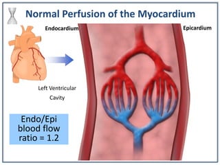 Normal Perfusion of the Myocardium
Endocardium Epicardium
Left Ventricular
Cavity
Endo/Epi
blood flow
ratio = 1.2
 