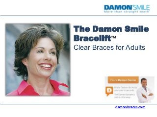 The Damon Smile
Bracelift™
Clear Braces for Adults
damonbraces.com
 