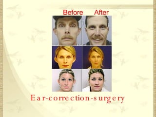 Ear-correction-surgery Before After 
