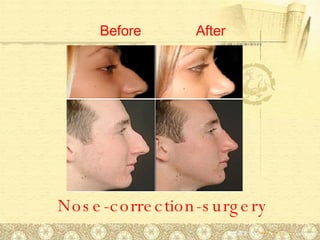 Nose-correction-surgery Before After 