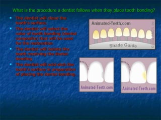 What is the procedure a dentist follows when they place tooth bonding?   The dentist will clean the tooth's surface.   The dentist will select the color of tooth bonding (dental composite) that will be used for the restoration   The dentist will isolate the tooth receiving the dental bonding The dentist will acid etch the tooth's surface in preparation of placing the dental bonding. 
