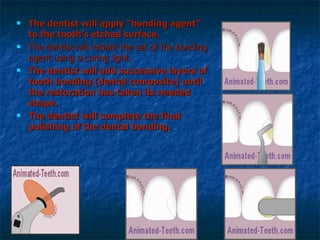 The dentist will apply "bonding agent" to the tooth's etched surface. The dentist will initiate the set of the bonding agent using a curing light.   The dentist will add successive layers of tooth bonding (dental composite) until the restoration has taken its needed shape. The dentist will complete the final polishing of the dental bonding. 
