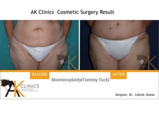 AK Clinics Cosmetic Surgery Result
 