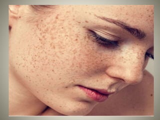 Prickly heat
• It is aslo called as heat rash/miliaria.
• It is itchy inflammation of superficial layers of skin,
typicall...