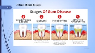 3 stages of gum diseases
09-02-2022
83
 