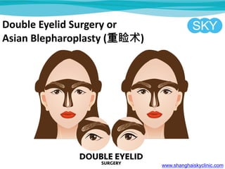 Double Eyelid Surgery or
Asian Blepharoplasty ()
www.shanghaiskyclinic.com
 