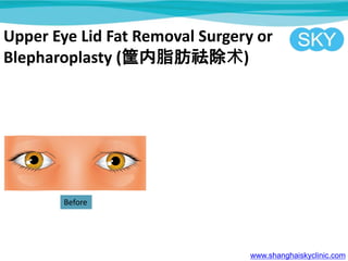 Upper Eye Lid Fat Removal Surgery or
Blepharoplasty (֬)
www.shanghaiskyclinic.com
Before
 