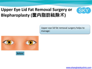 Upper Eye Lid Fat Removal Surgery or
Blepharoplasty (֬)
Upper eye lid fat removal surgery helps to
manage:
www.shanghaiskyclinic.com
Before
 