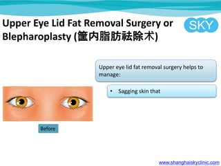 Upper Eye Lid Fat Removal Surgery or
Blepharoplasty (֬)
Upper eye lid fat removal surgery helps to
manage:
? Sagging skin that
www.shanghaiskyclinic.com
Before
 