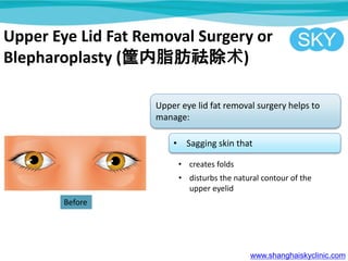Upper Eye Lid Fat Removal Surgery or
Blepharoplasty (֬)
Upper eye lid fat removal surgery helps to
manage:
? Sagging skin that
? creates folds
? disturbs the natural contour of the
upper eyelid
www.shanghaiskyclinic.com
Before
 