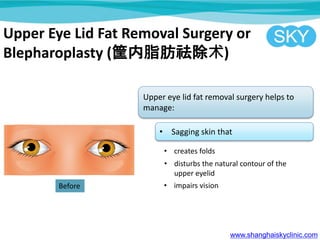 Upper Eye Lid Fat Removal Surgery or
Blepharoplasty (֬)
Upper eye lid fat removal surgery helps to
manage:
? Sagging skin that
? creates folds
? disturbs the natural contour of the
upper eyelid
? impairs vision
www.shanghaiskyclinic.com
Before
 
