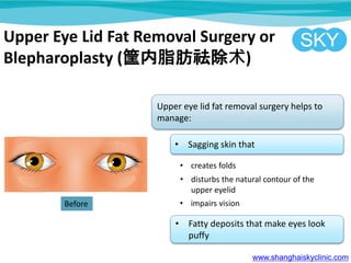 Upper Eye Lid Fat Removal Surgery or
Blepharoplasty (֬)
Upper eye lid fat removal surgery helps to
manage:
? Sagging skin that
? Fatty deposits that make eyes look
puffy
? creates folds
? disturbs the natural contour of the
upper eyelid
? impairs vision
www.shanghaiskyclinic.com
Before
 