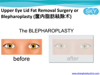 Upper Eye Lid Fat Removal Surgery or
Blepharoplasty (֬)
www.shanghaiskyclinic.com
 