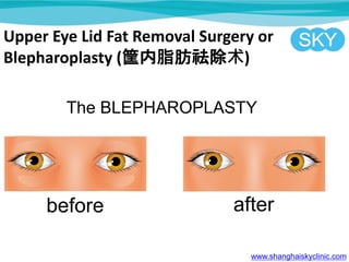 Upper Eye Lid Fat Removal Surgery or
Blepharoplasty (֬)
www.shanghaiskyclinic.com
 
