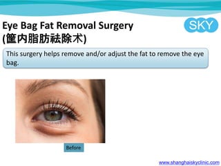 Eye Bag Fat Removal Surgery
(֬)
This surgery helps remove and/or adjust the fat to remove the eye
bag.
www.shanghaiskyclinic.com
Before
 