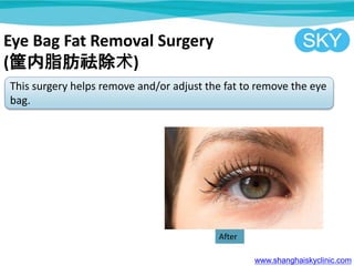 Eye Bag Fat Removal Surgery
(֬)
This surgery helps remove and/or adjust the fat to remove the eye
bag.
www.shanghaiskyclinic.com
After
 