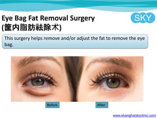 Eye Bag Fat Removal Surgery
(֬)
This surgery helps remove and/or adjust the fat to remove the eye
bag.
www.shanghaiskyclinic.com
Before After
 