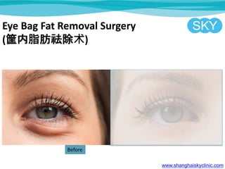 Eye Bag Fat Removal Surgery
(֬)
www.shanghaiskyclinic.com
Before
 
