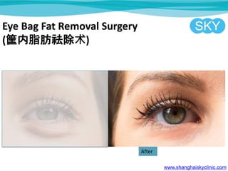 Eye Bag Fat Removal Surgery
(֬)
www.shanghaiskyclinic.com
After
 