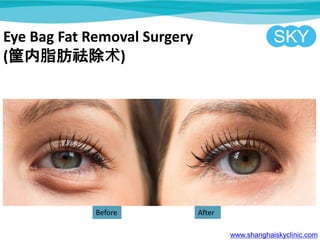 Eye Bag Fat Removal Surgery
(֬)
www.shanghaiskyclinic.com
Before After
 